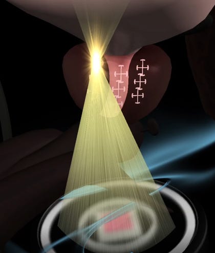 Trans-perineal focal therapy of the prostate | Animation: NINA Medical